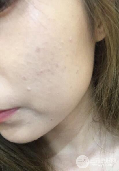 水光补水嫩肤果图前后对比和恢复过程真实案例分享