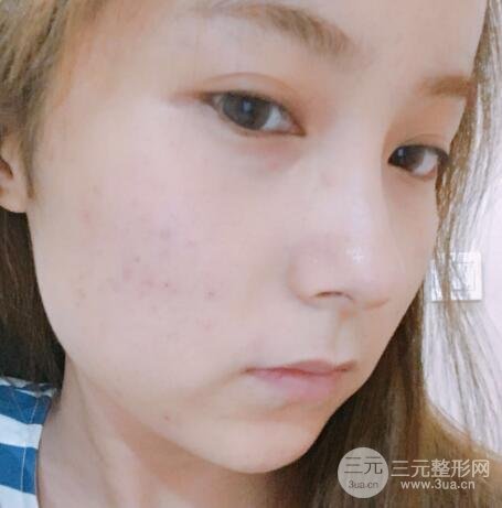 水光补水嫩肤果图前后对比和恢复过程真实案例分享