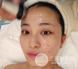 痘坑痘疤要怎么修复？果酸换肤后脸果图和真实案例分享