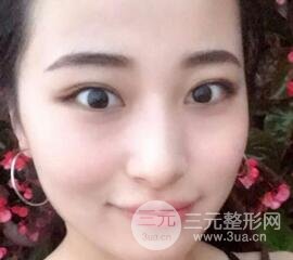 痘坑痘疤要怎么修复？果酸换肤后脸果图和真实案例分享