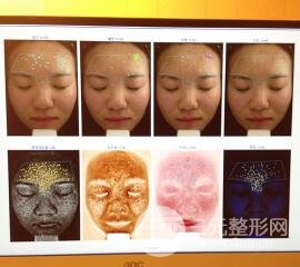 痘坑痘疤要怎么修复？果酸换肤后脸果图和真实案例分享