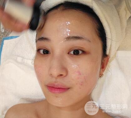 痘坑痘疤要怎么修复？果酸换肤后脸果图和真实案例分享