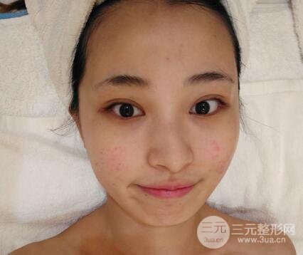 痘坑痘疤要怎么修复？果酸换肤后脸果图和真实案例分享