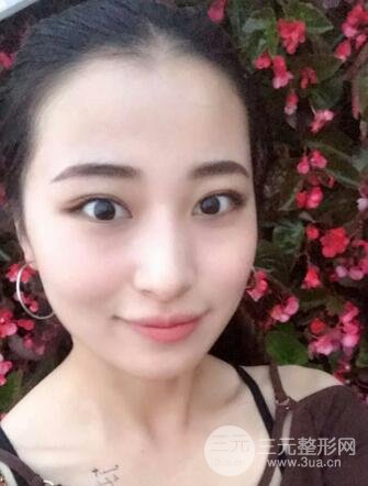 痘坑痘疤要怎么修复？果酸换肤后脸果图和真实案例分享