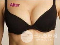 假体隆胸好不好?降低风险吗？会不会影响怀孕哺乳?