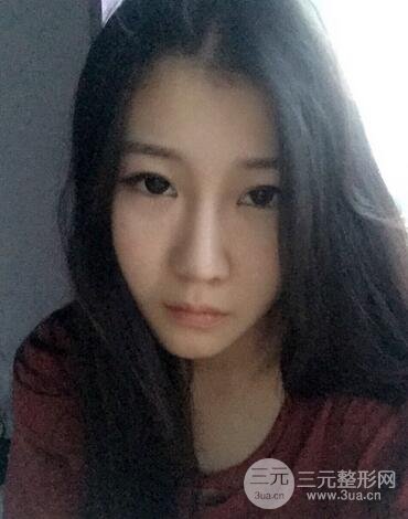 长沙鹏爱隆鼻整形果展示 恢复过程图