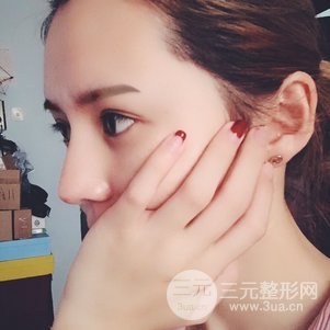 隆鼻整形多少钱 李圣利隆鼻整形案例