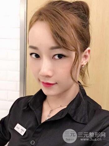 自体脂肪填充后的照片 前后果对比--美联致美