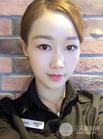 自体脂肪填充后的照片 前后果对比--美联致美