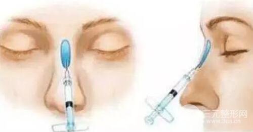 注射玻尿酸隆鼻美容微整形前后原理图