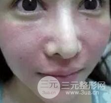 我做了光子嫩肤几天起而且价格便宜前后对比照片案例