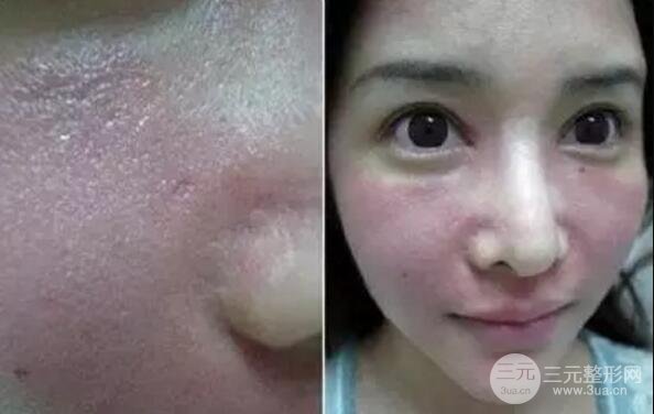 我做了光子嫩肤几天起而且价格便宜前后对比照片案例