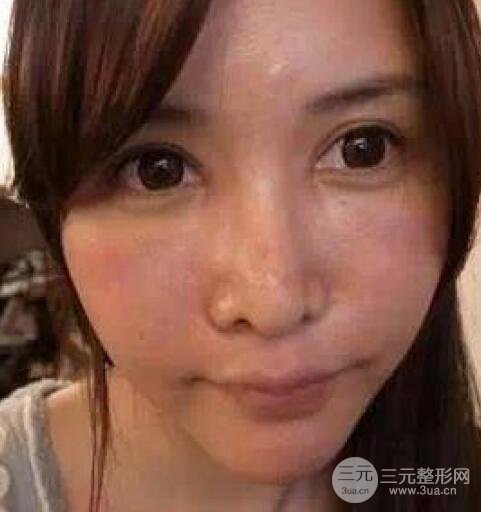 我做了光子嫩肤几天起而且价格便宜前后对比照片案例