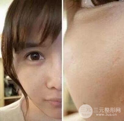 我做了光子嫩肤几天起而且价格便宜前后对比照片案例
