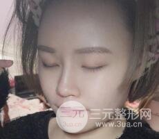 全脸脂肪填充价格 恢复过程图 真实案例分享