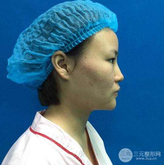 全脸脂肪填充价格 恢复过程图 真实案例分享