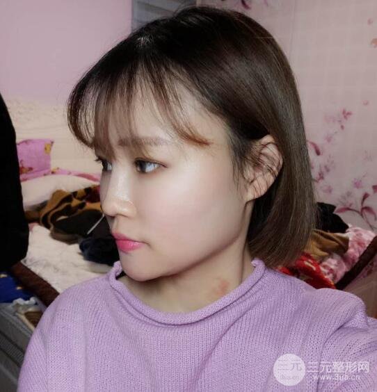 全脸脂肪填充价格 恢复过程图 真实案例分享