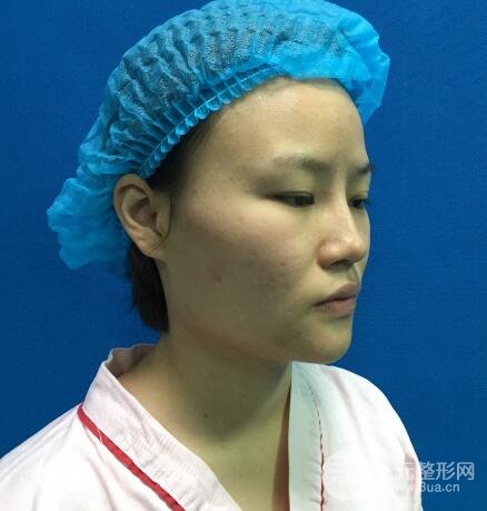 全脸脂肪填充价格 恢复过程图 真实案例分享