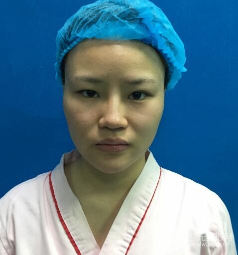 全脸脂肪填充价格 恢复过程图 真实案例分享