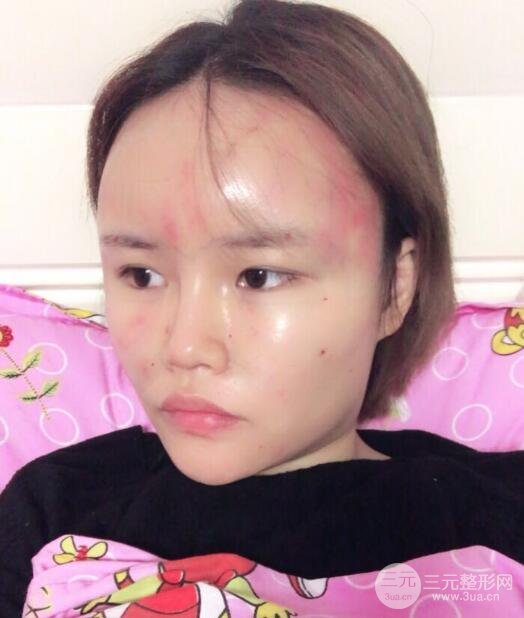 全脸脂肪填充价格 恢复过程图 真实案例分享