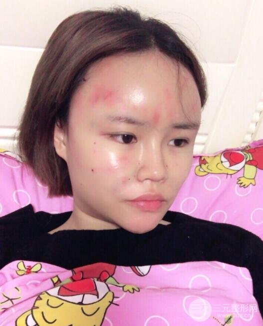 全脸脂肪填充价格 恢复过程图 真实案例分享