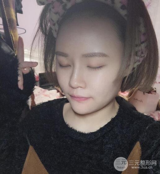 全脸脂肪填充价格 恢复过程图 真实案例分享