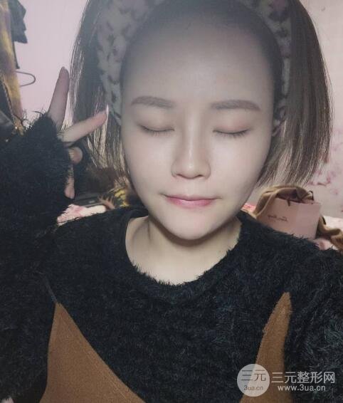 全脸脂肪填充价格 恢复过程图 真实案例分享