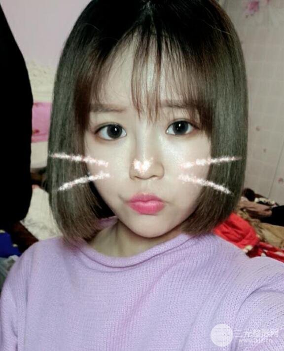 全脸脂肪填充价格 恢复过程图 真实案例分享