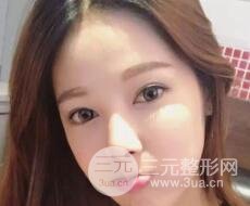 大腿抽脂做脸部脂肪填充 包括太阳穴和额头价格果分享