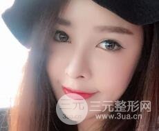 大腿抽脂做脸部脂肪填充 包括太阳穴和额头价格果分享