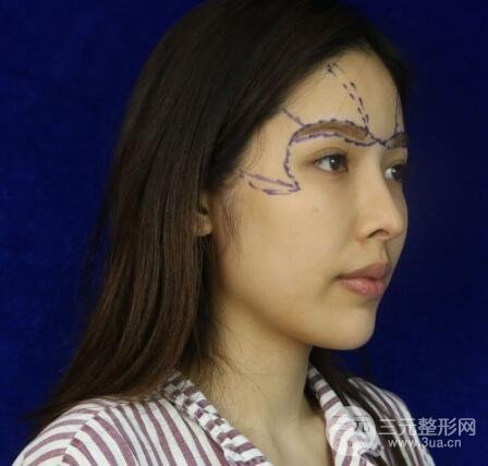 大腿抽脂做脸部脂肪填充 包括太阳穴和额头价格果分享