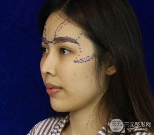 大腿抽脂做脸部脂肪填充 包括太阳穴和额头价格果分享