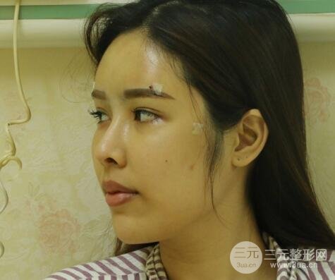 大腿抽脂做脸部脂肪填充 包括太阳穴和额头价格果分享