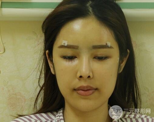 大腿抽脂做脸部脂肪填充 包括太阳穴和额头价格果分享