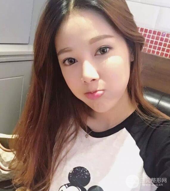 大腿抽脂做脸部脂肪填充 包括太阳穴和额头价格果分享