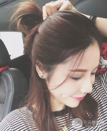 大腿抽脂做脸部脂肪填充 包括太阳穴和额头价格果分享