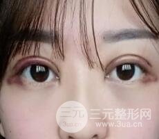 肿泡眼单眼皮变双眼皮真实切开双眼皮案例和对比图
