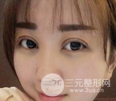 肿泡眼单眼皮变双眼皮真实切开双眼皮案例和对比图