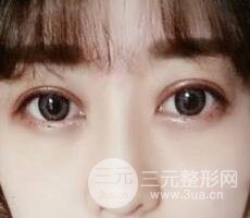 肿泡眼单眼皮变双眼皮真实切开双眼皮案例和对比图
