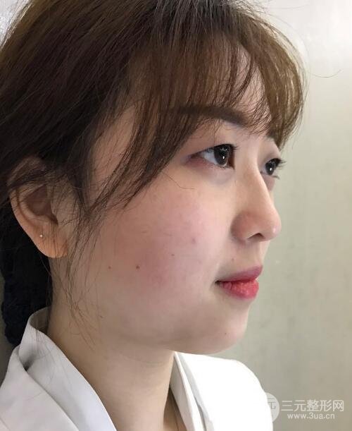 肿泡眼单眼皮变双眼皮真实切开双眼皮案例和对比图