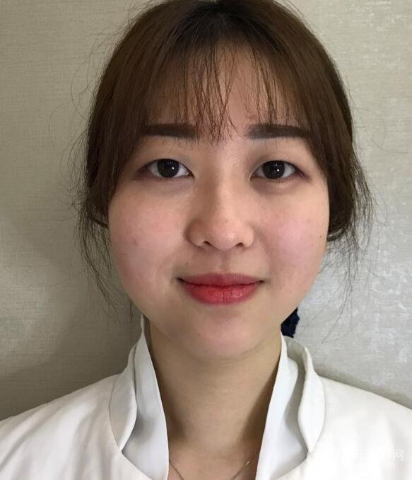 肿泡眼单眼皮变双眼皮真实切开双眼皮案例和对比图