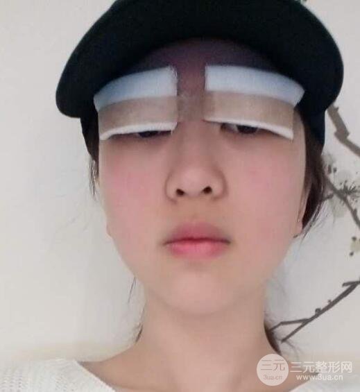 肿泡眼单眼皮变双眼皮真实切开双眼皮案例和对比图