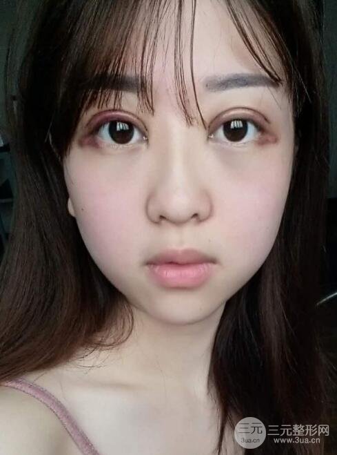 肿泡眼单眼皮变双眼皮真实切开双眼皮案例和对比图