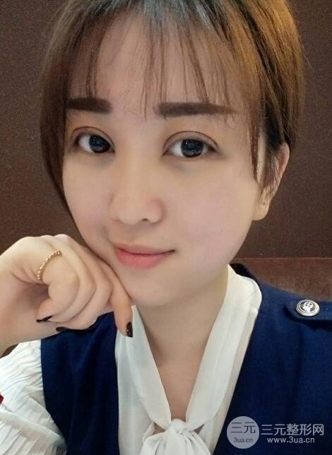 肿泡眼单眼皮变双眼皮真实切开双眼皮案例和对比图