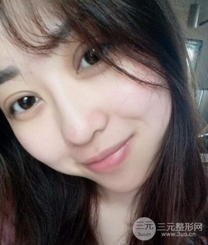 肿泡眼单眼皮变双眼皮真实切开双眼皮案例和对比图