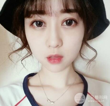 肿泡眼单眼皮变双眼皮真实切开双眼皮案例和对比图