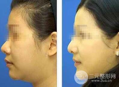 面部吸脂大概要多少钱？面部吸脂减肥价格表和前后果图片