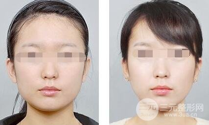 面部吸脂大概要多少钱？面部吸脂减肥价格表和前后果图片