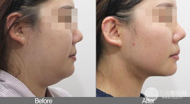 面部吸脂大概要多少钱？面部吸脂减肥价格表和前后果图片