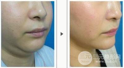 面部吸脂大概要多少钱？面部吸脂减肥价格表和前后果图片